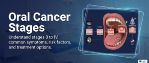 Oral Cancer Stages: Symptoms, Causes, and Treatment