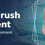 Oral Thrush Ointment: Antifungal Gels, Treatment and Prevention