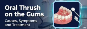 Oral Thrush on the Gums: Causes, Symptoms, and Treatment