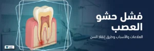 فشل حشو العصب: العلامات والأسباب ومتى يمكن إنقاذ السن؟