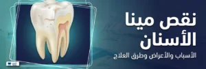 نقص مينا الأسنان: الأسباب والأعراض وطرق العلاج عند الأطفال والبالغين